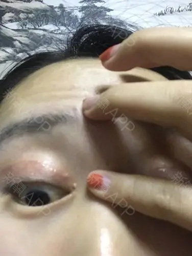 双眼皮已经做了80多天了在半个月左右时候开始长增生_圈子-新氧美容