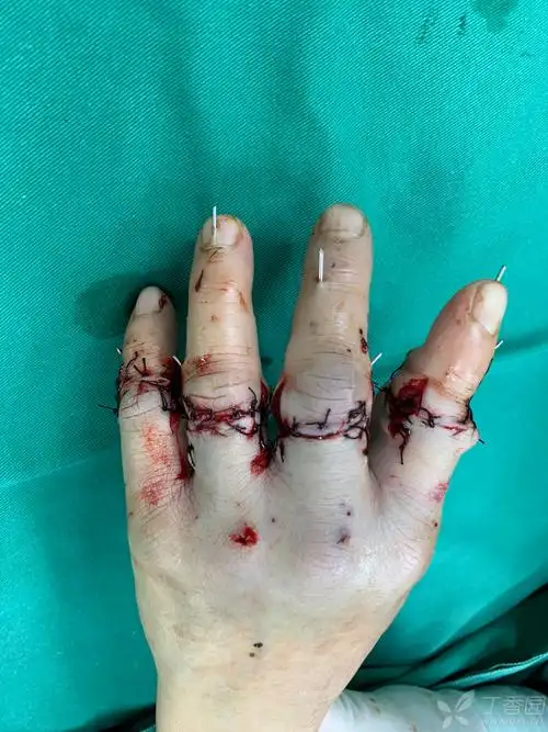 手外科的那些事