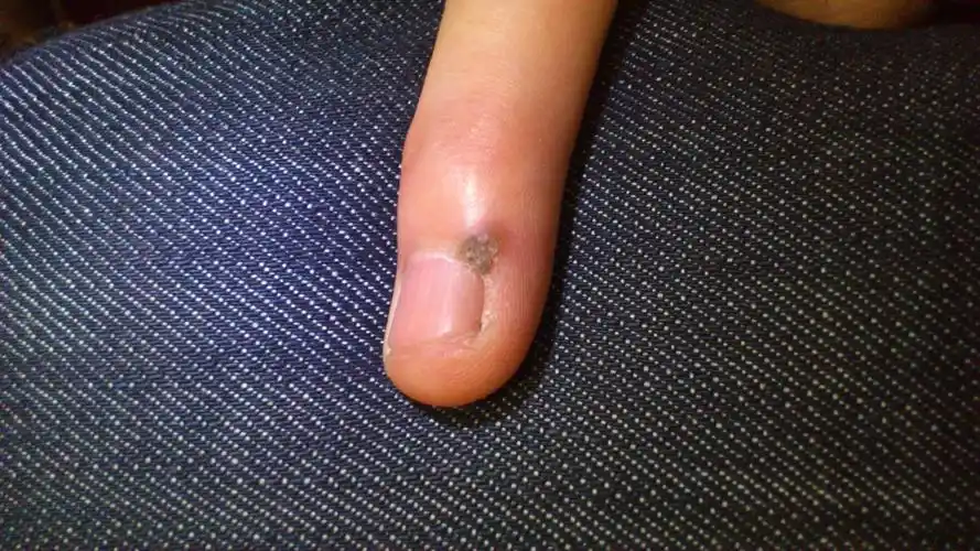 手上长了个东西·4个月前芝麻大·现在变大了·不是血泡,不疼不养