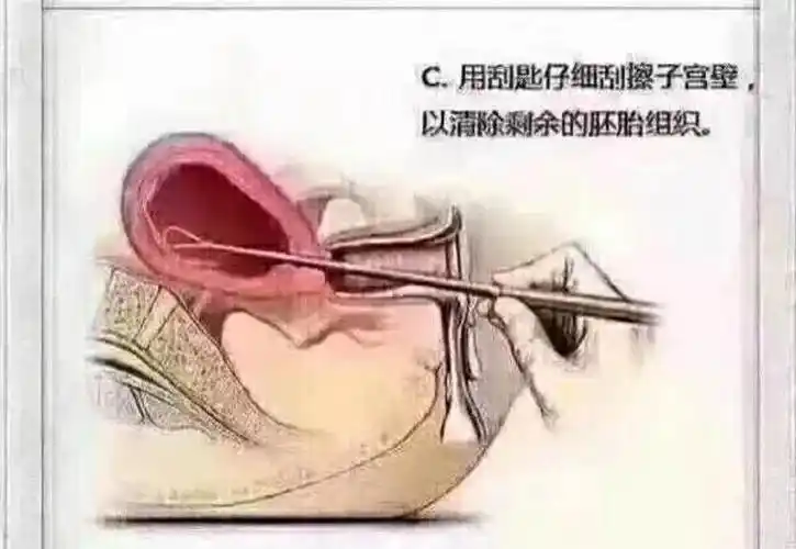 人工流产术图示