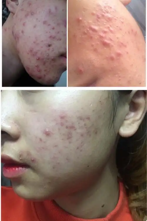 明星爆痘,你也爆痘,大家都爆痘,怎么办?有请高人解答!