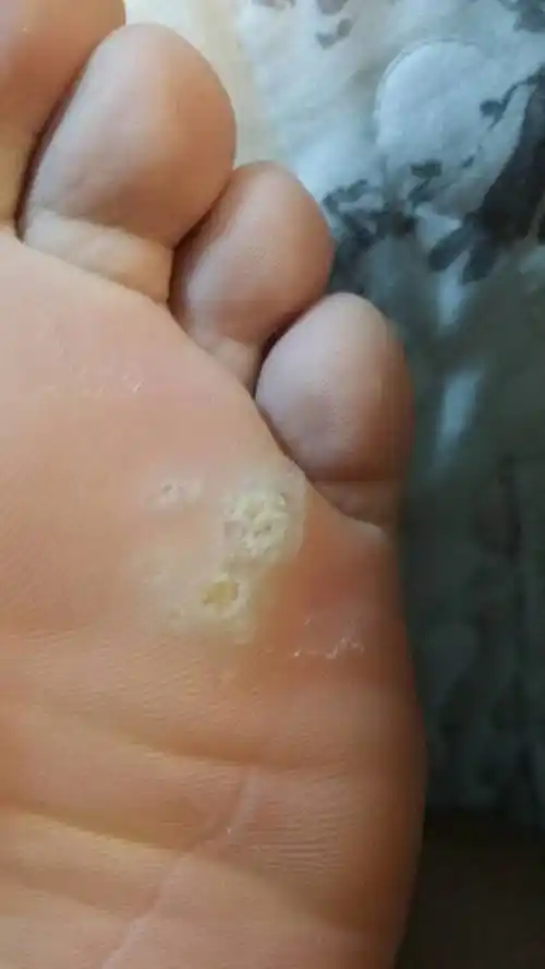 脚底长了这个东西不痛不痒摸起来硬硬的,长了很长时间了,这是什么东西