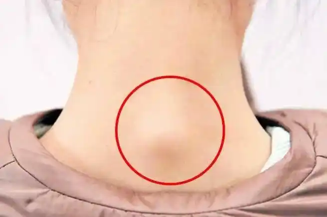 是不是脖子中后偏下部鼓出来一个包?你是不是经常觉得昏昏沉沉?