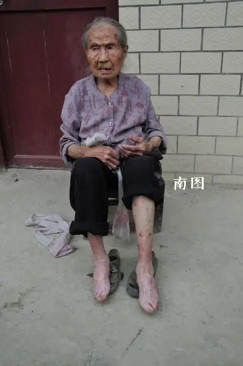 胡玉南老人.她每天都帮家人喂猪食,身体硬朗.胡玉南老人在包裹脚布.