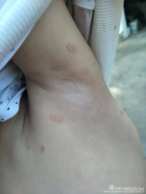 如何诊断玫瑰糠疹?