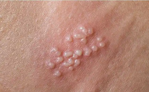 25岁空姐查出hpv,大夫:若身上长"小疙瘩",去妇科走一趟吧