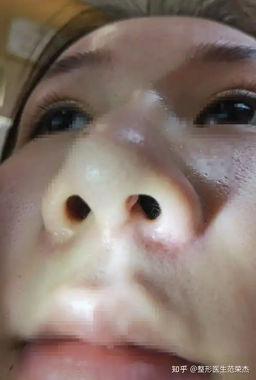 隆鼻术后鼻小柱有凸出是增生了吗