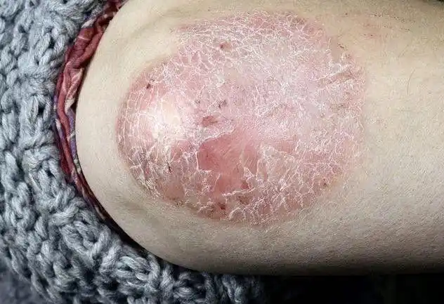 掌跖脓疱型牛皮癣图片
