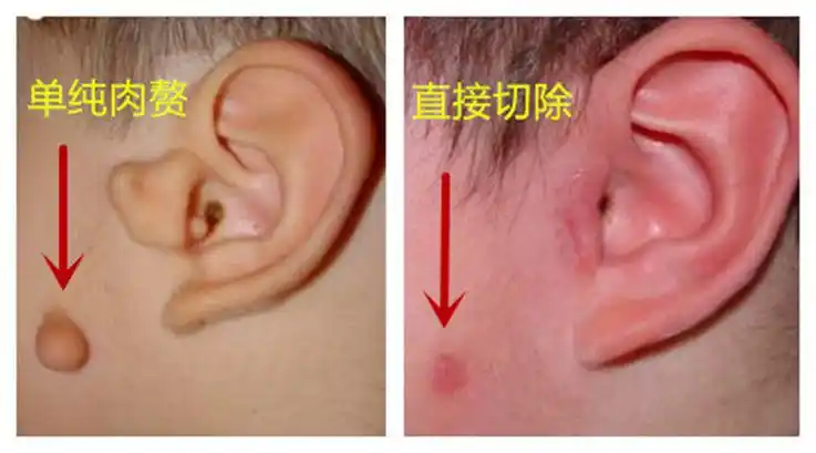 宝宝附耳拴马桩并非是福耳手术不能直接一切了之