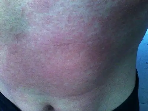 肚子上有小红点;前天开始;之前有过一次