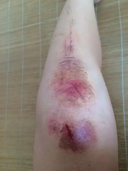 小腿摔伤后如何快速消肿? - 知乎