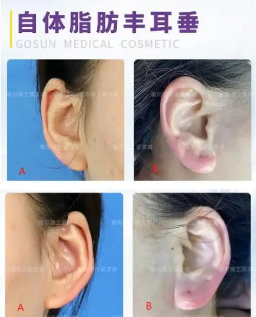 丰耳垂术助你拥有饱满丰盈的耳垂
