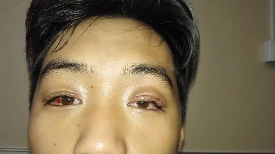 cfs治疗上睑下垂达到很满意的效果 - 好大夫在线