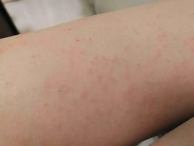 孩子腿上密密麻麻的小红疙瘩?