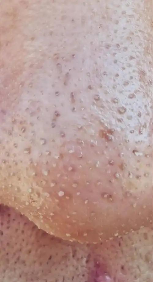 油性皮肤有黑头毛孔粗大怎么办?用什么能去除黑头和收缩毛孔?