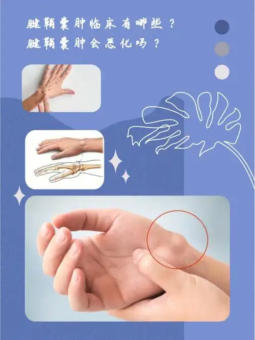 新加坡骨科腱鞘囊肿临床症状有哪些
