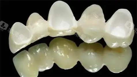 全瓷连桥冠实例图