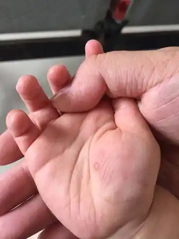 急急急,宝宝手上长了一个透明痘痘,知道的宝妈帮忙看看严重吗