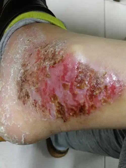 近两年左侧内踝下部皮肤反复溃烂,这是什么皮肤病 - 皮肤及性传播疾病