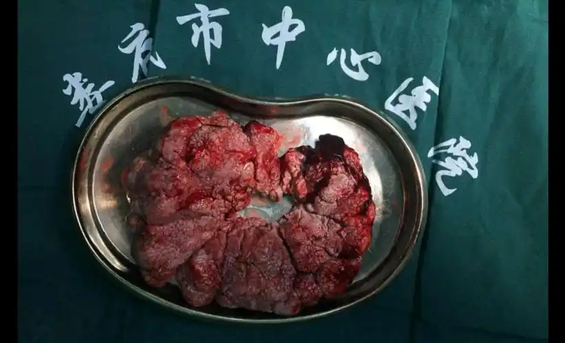 上回到病房,当醒来的刘老伯发现令他坐立不安数年的肿瘤终于被拿掉时