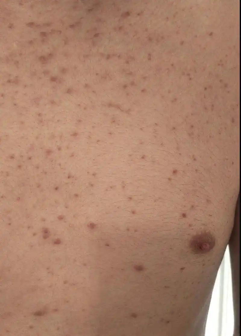 中国医师节# 男性早期梅毒表现,现在4个月了.