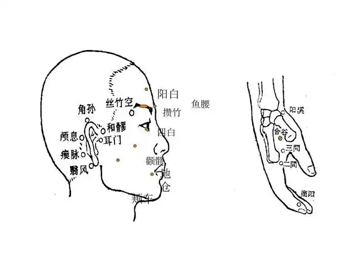 面瘫的中医针灸治疗