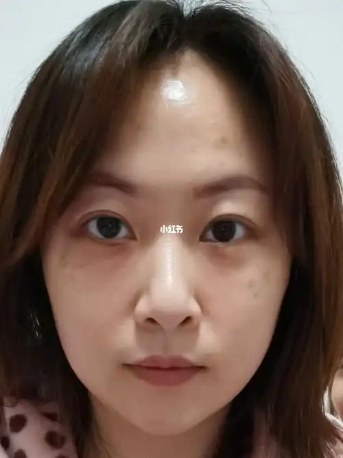 外切眼袋46天～增生