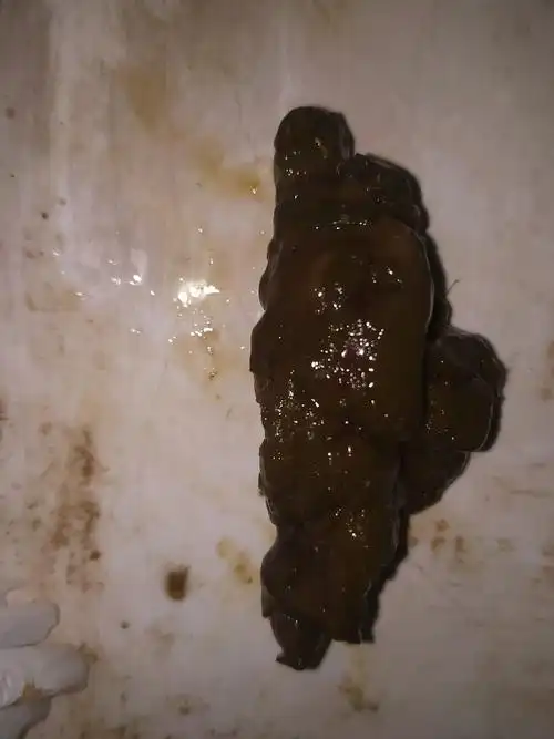 两天没有拉大便,今天拉了一点点大便带一条血迹,大便粘液,怎么回事?