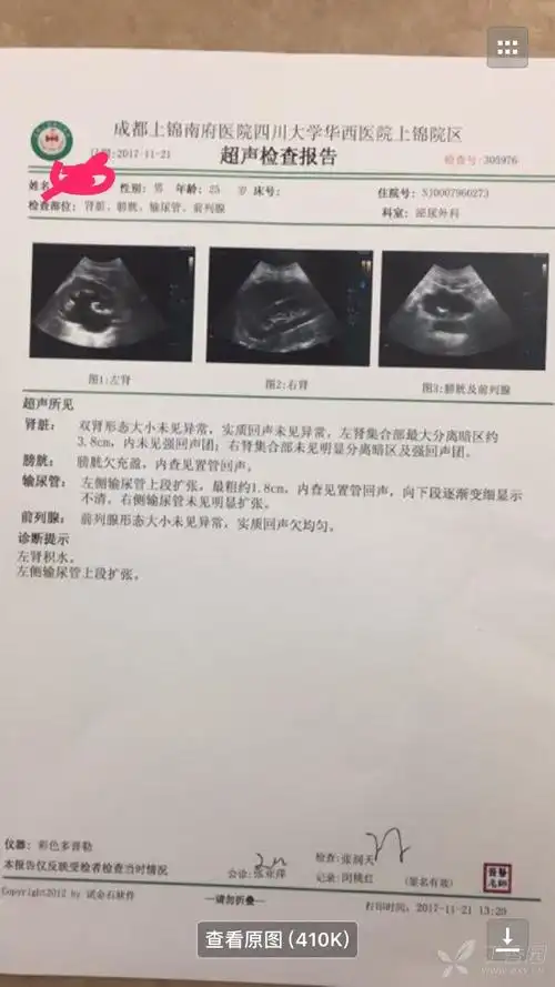 肾结石,肾积水怎么治疗 _肾积水怎么治疗-第1张图片-潮百科