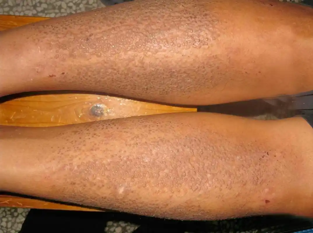 身体出现密密麻麻的小黑点还发痒是怎么回事?