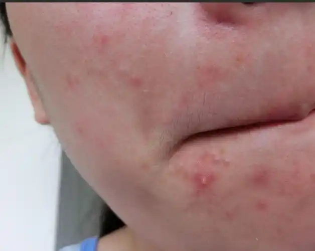 脸上长了密密麻麻皮肤色的痘痘 求医生确诊这个叫什么东西