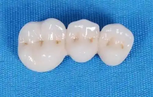 lava全瓷牙产自大名鼎鼎的美国3m公司,目前在各个地区都非常受欢迎