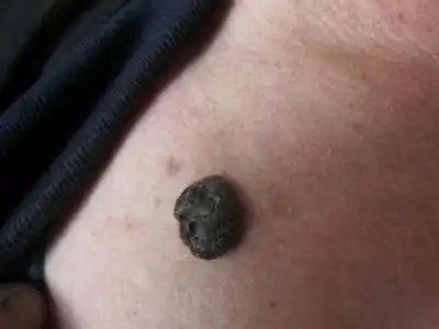 黑色素瘤能不能治愈