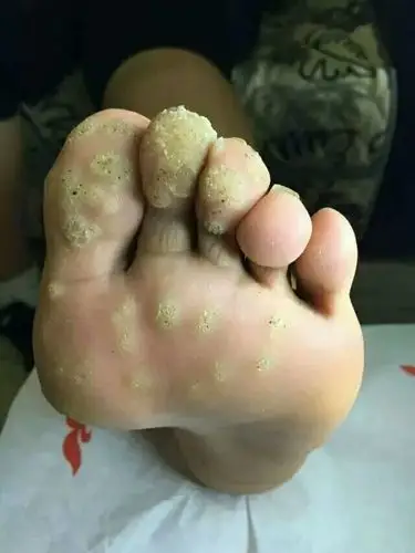 别把跎疣当鸡眼