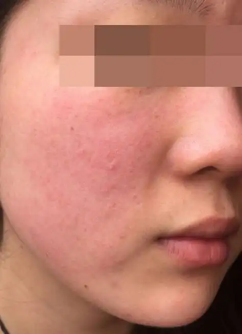 分享我的敏感皮肤红血丝修复经历