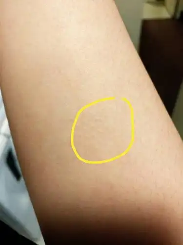 手臂上长了小疹子