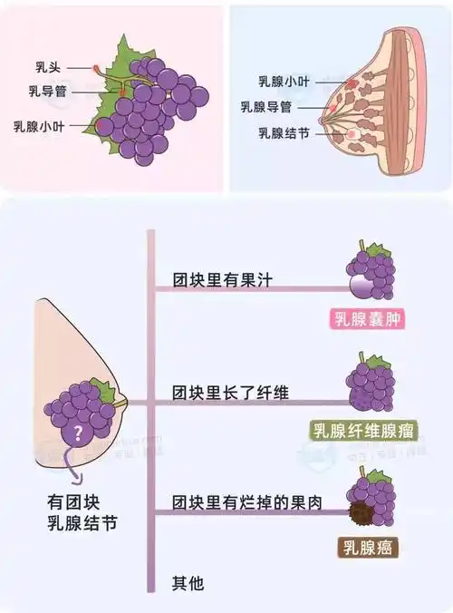 女同胞必看乳腺结节会癌变吗得了还能不能买保险