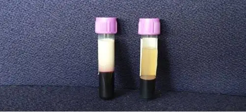 罕见病例甘油三酯高达25血清竟然是透明的