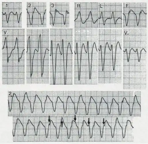 疾病诊疗|1 例室速患者的心电图表现