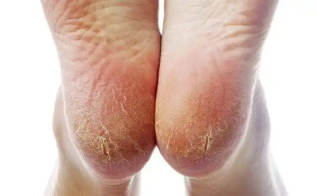 秋冬季节脚部干燥裂口处理小技巧