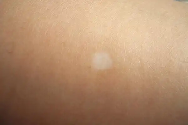 早期白癜风患者最初发病仅是白斑,无其他症状.