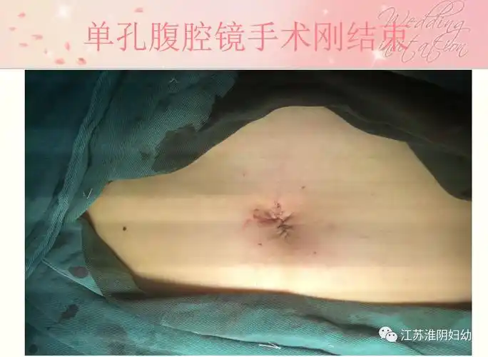 前沿医术小孔藏肚脐宫外孕手术0疤痕不再是梦想