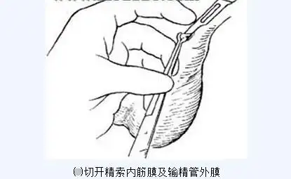传说中的男性结扎手术全过程(附图), 做了真的会变成"太监"吗?