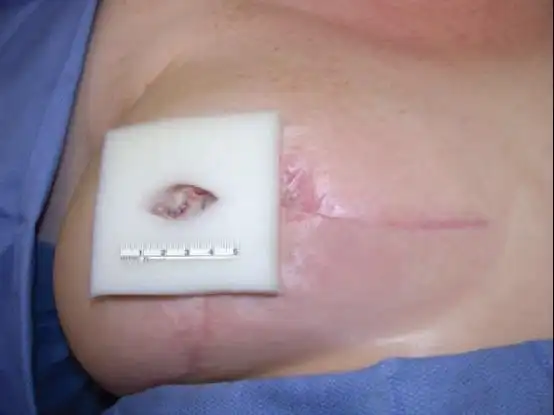 抗生素油膏涂擦保护乳头皮瓣表面,mastisol 液体粘合剂涂布再造乳房