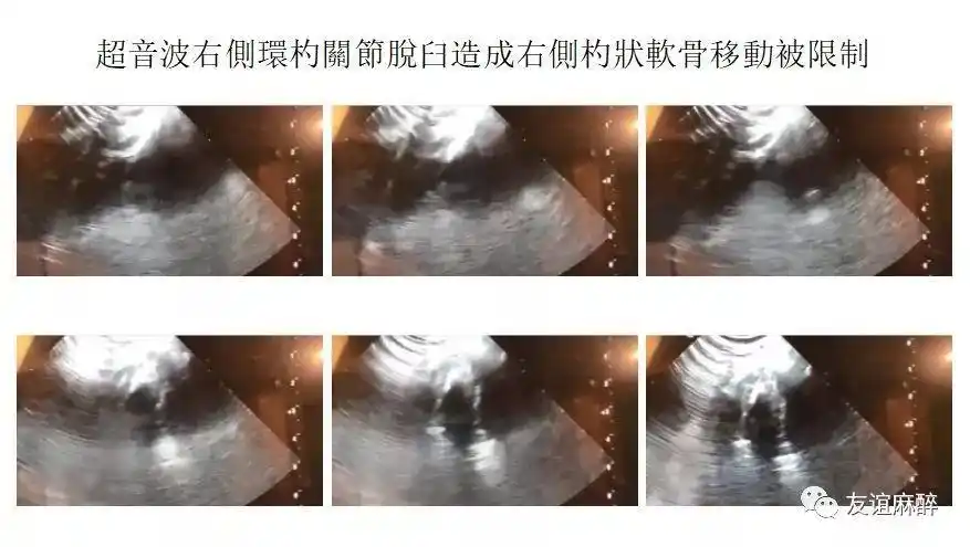 围术期出现环杓关节脱位,如何诊断处理?