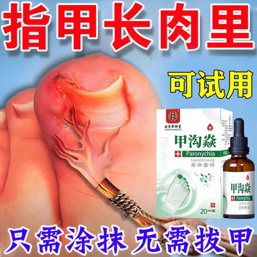 甲沟炎专用i的药去肉芽指甲长肉里脱甲嵌甲消红肿止i痛治手脚化脓流