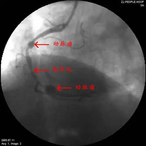 我科使用冠脉带膜支架治疗冠状动脉瘤