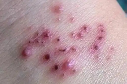 蛇盘疮最佳治疗方法蛇盘疮长一圈真的会要人命蛇盘疮疼痛难忍该如何