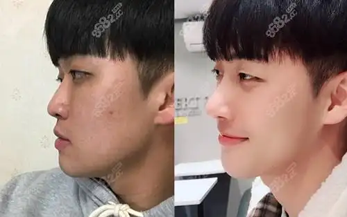 韩国premier普瑞美男生鼻综合对比照片