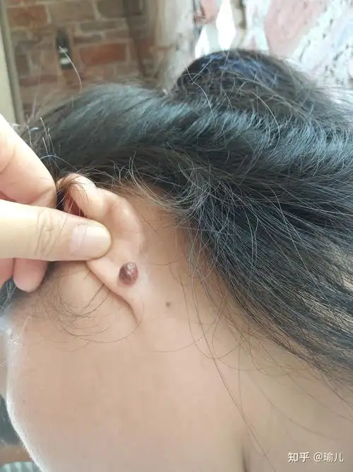 耳朵后面长了个疙瘩是什么东西啊求助求助